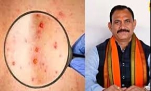 मंकी पॉक्स (एम-पॉक्स) नामक बीमारी के बचाव व रोकथाम हेतु एडवायजरी जारी