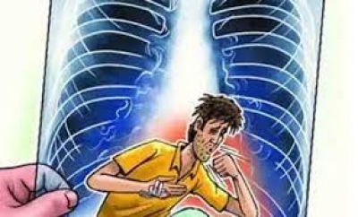 प्रदेश में टीबी के अति संवेदनशील समूह का होगा मानचित्रण