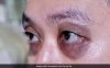 आलू के रस में इस एक चीज को मिलाकर लगा लिया तो डार्क सर्कल्स की हो जाएगी छुट्टी, चमक जाएगी आंखों के आस-पास की स्किन